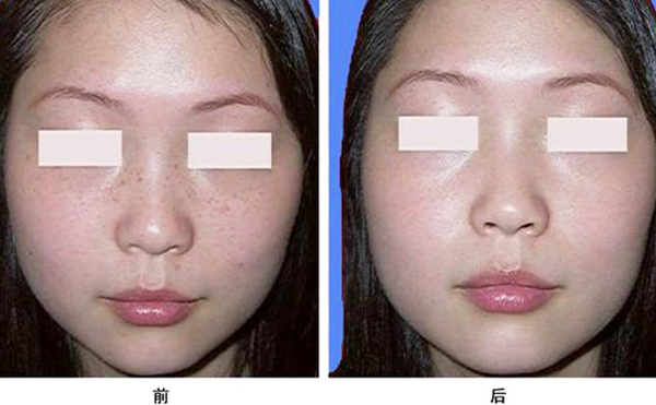 激光祛斑真的能去干凈嗎？