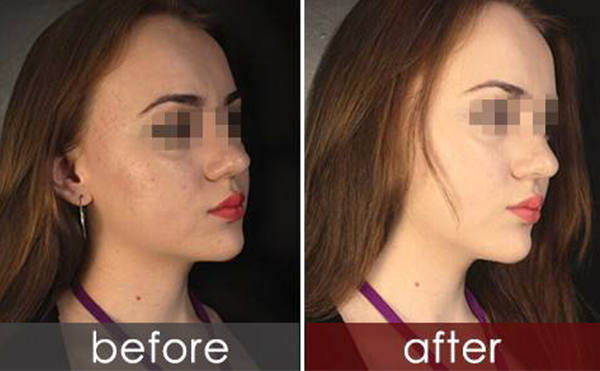 白瓷娃娃有什么風(fēng)險?怎么預(yù)防?