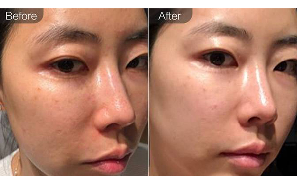 e光嫩膚是什么？