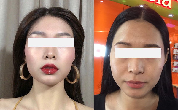 激光脫發(fā)際線效果怎么樣？