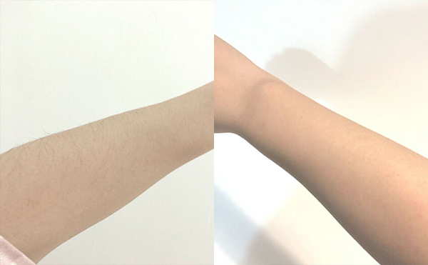 冰點手臂脫毛