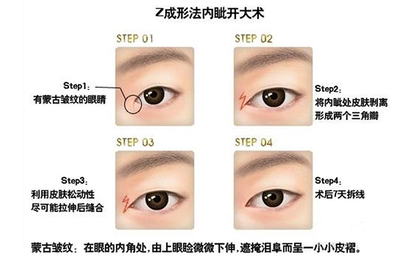 開內眼角復雜嗎?手術過程是什么?