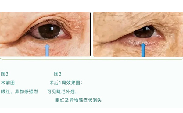 老年人眼瞼內(nèi)翻原因有哪些?老年人眼瞼內(nèi)翻怎樣治療?