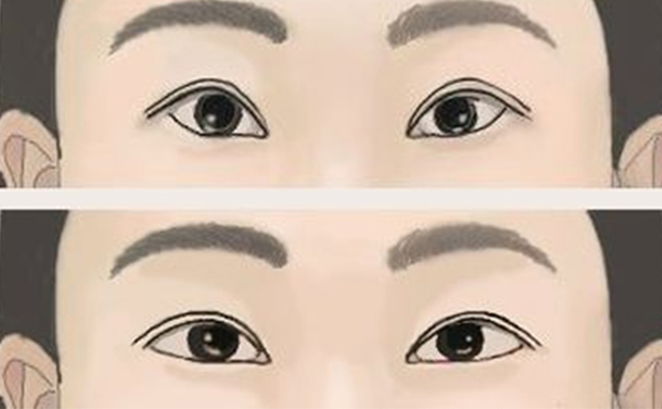 倒三角眼怎么改善?有什么注意事項(xiàng)?