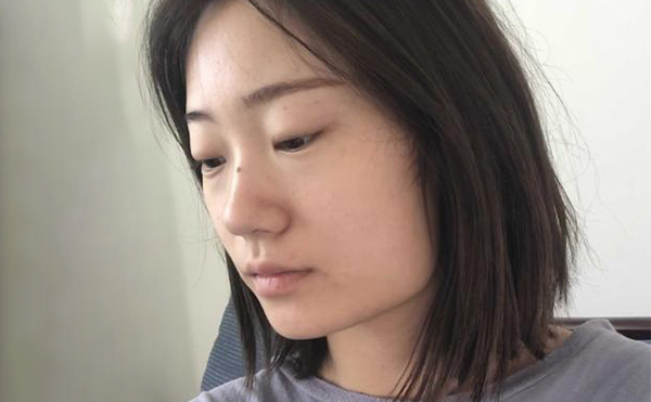 下頜角整形適宜人群有哪些？