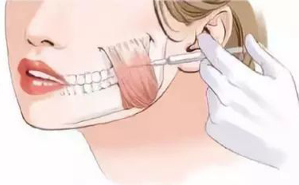 哪些小習(xí)慣會(huì)導(dǎo)致咬肌肥大？咬肌肥大怎么辦？