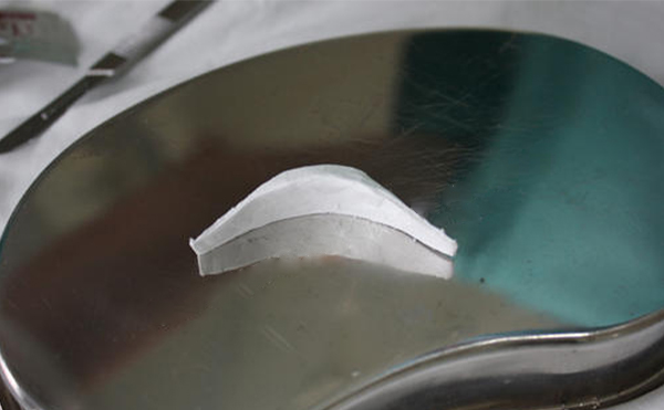 膨體豐下巴術(shù)后下巴的手感真實嗎?術(shù)后如何護(hù)理?