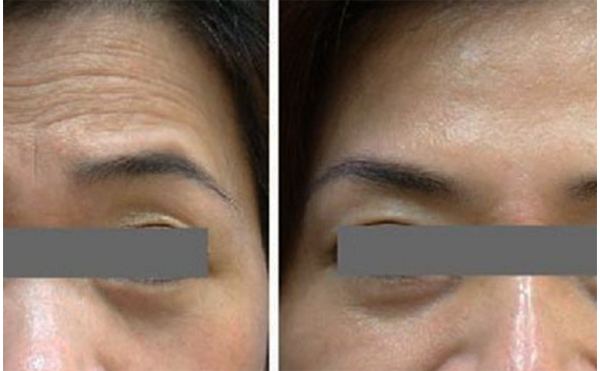 玻尿酸去抬頭紋能維持多久？