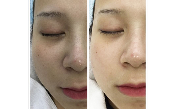 激光祛斑有哪些誤區(qū)？