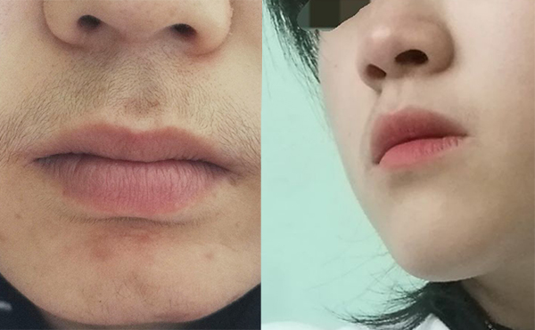 激光脫毛的效果怎么樣？