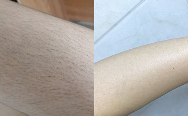 激光手臂脫毛安全嗎？