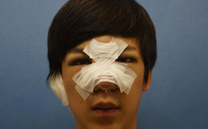 駝峰鼻矯正手術(shù)多少錢？駝峰鼻矯正有危險(xiǎn)嗎？