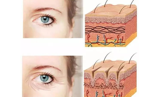 自體脂肪填充眼瞼凹陷效果怎么樣?有哪些注意事項(xiàng)?