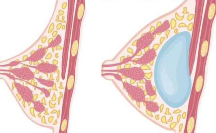 硅膠假體豐胸需要多少錢？硅膠假體豐胸可以保持多久？