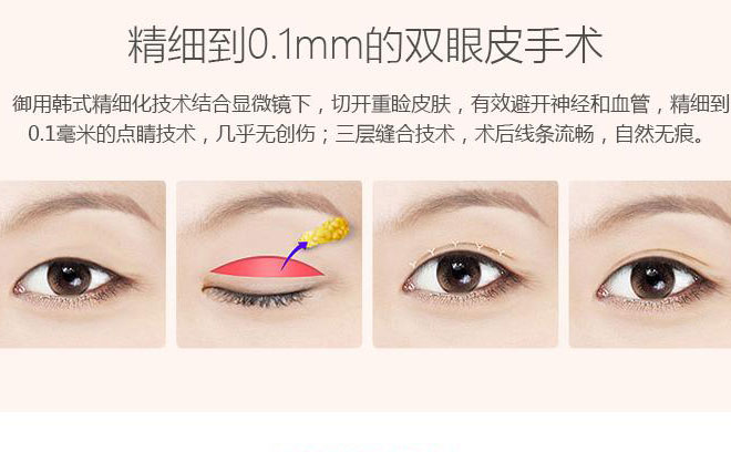 韓式三點(diǎn)雙眼皮一般要多少錢？