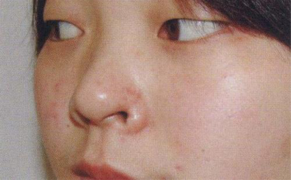 鼻翼缺損是怎么修復的？鼻翼缺損的修復效果怎么樣
