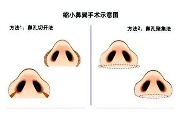  鼻翼縮小有后遺癥嗎？會(huì)不會(huì)反彈
