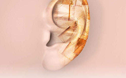 全耳再造術(shù)多少錢？全耳再造需要多久時間？