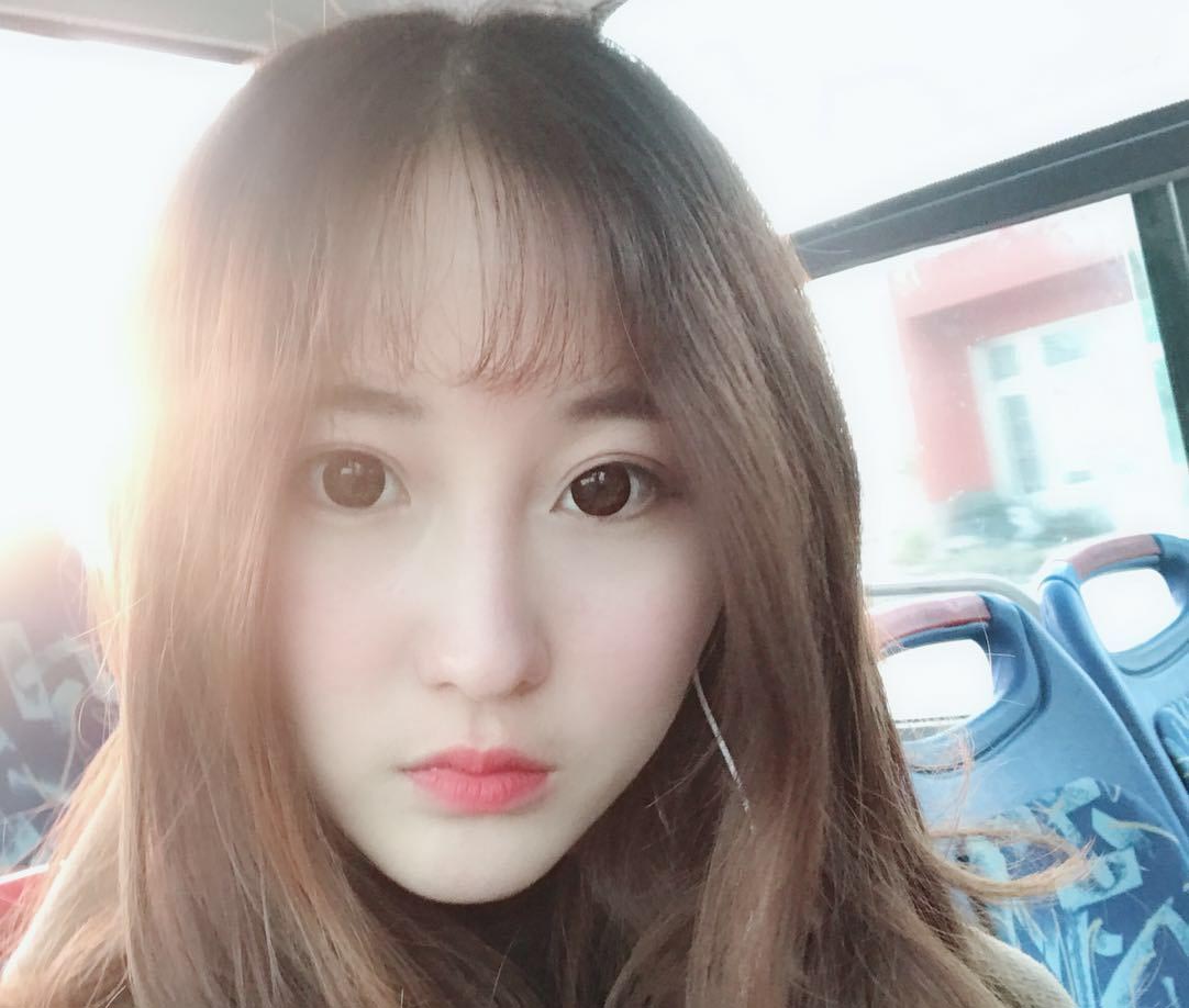 雙眼皮修復(fù)效果對(duì)比圖5