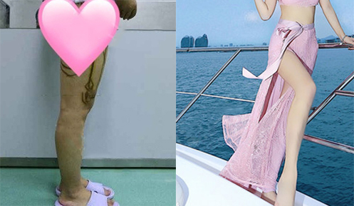 大腿吸脂效果對比