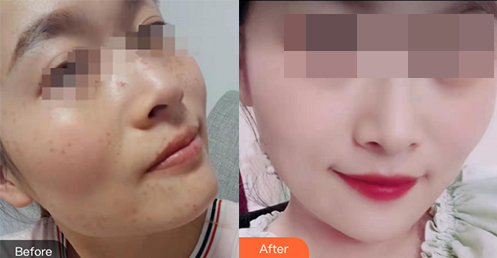 南寧東方整形祛斑案例效果對(duì)比1