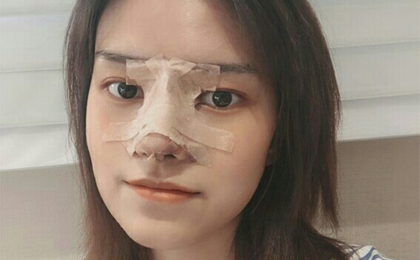 隆鼻術(shù)后第三天