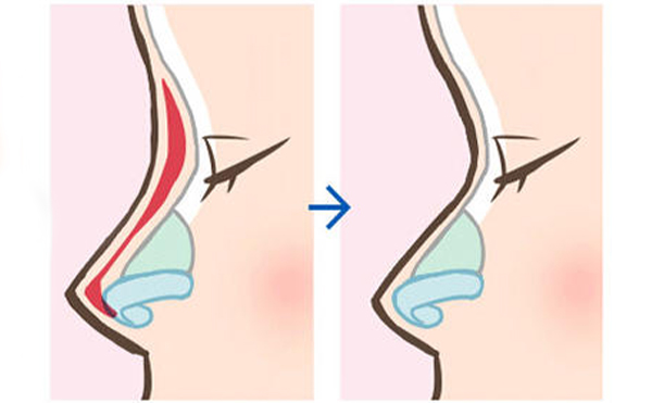 隆鼻假體取出后鼻子會不會和之前一樣?怎么做能盡快恢復(fù)原樣?