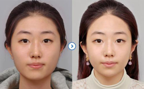 瘦臉針注射后注意事項