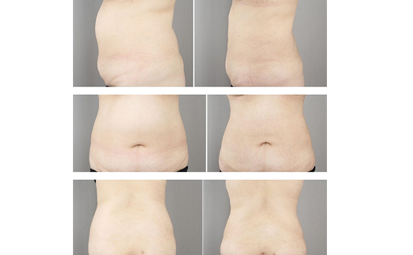 產(chǎn)后多久可以做腹部吸脂？