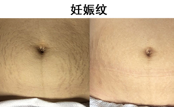 肥胖紋和妊娠紋有什么區(qū)別?有共同點(diǎn)嗎?
