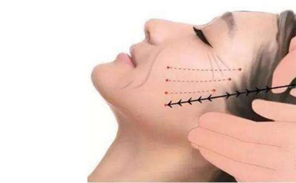 線雕提升適合哪些人做？