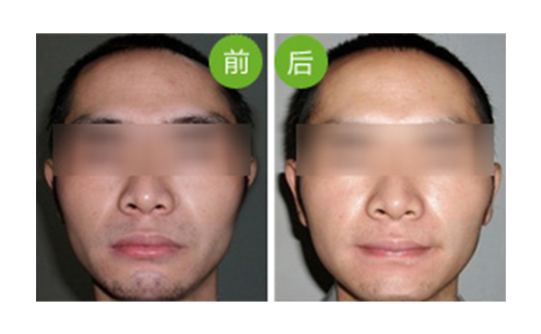 冰點面部脫毛值得做嗎？