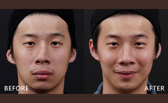 鼻骨矯正手術(shù)多少錢？鼻骨矯正手術(shù)危險嗎？