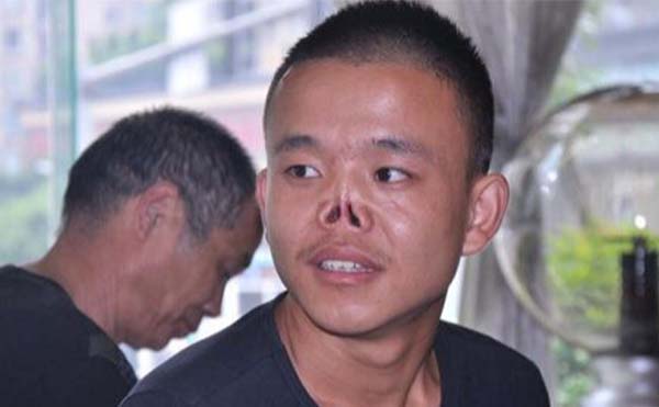 鼻再造手術有什么風險?