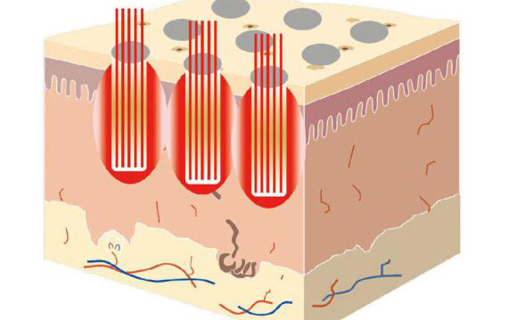 點(diǎn)陣激光祛斑后多久消失？