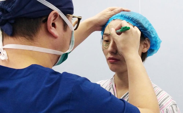 自體脂肪填充面部能保持多長時間？