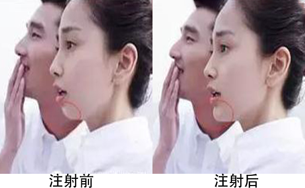 膨體隆下巴容易引發(fā)感染嗎?恢復(fù)后手術(shù)切口會不會被人被看出來?