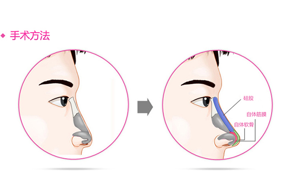 假體隆鼻的優(yōu)點