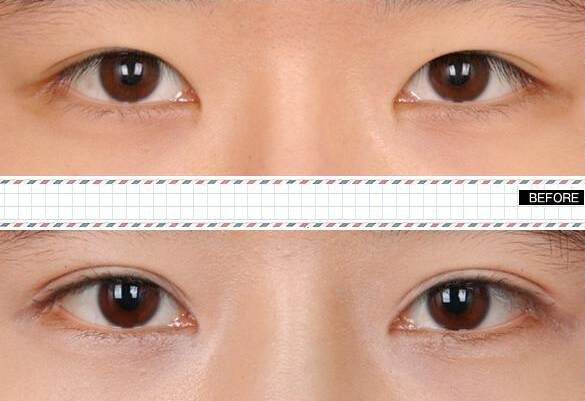 做雙眼皮價格是多少？哪種眼睛適合做雙眼皮呢?