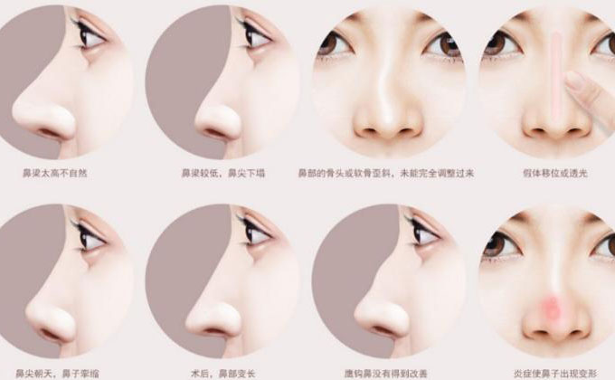 鼻尖整形大概多少錢？