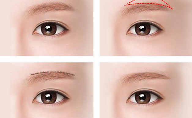 切眉除皺效果好嗎?