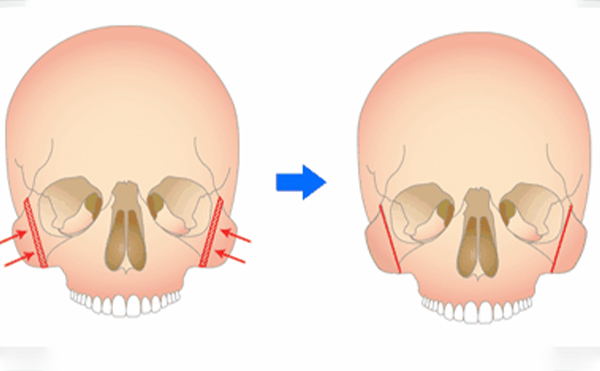 重慶藝星顴骨降低是怎么做的？術(shù)后要注意什么？