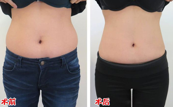 腹部吸脂效果如何？