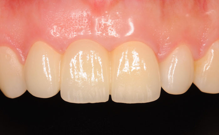 門牙種植牙需要多少錢一顆？