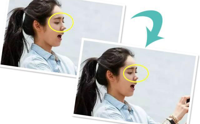 朝天鼻手術(shù)需要多少錢？