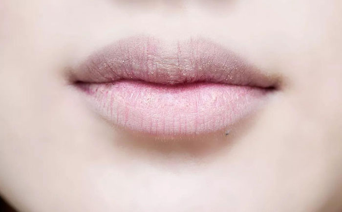 厚唇改薄多久完全恢復(fù)？