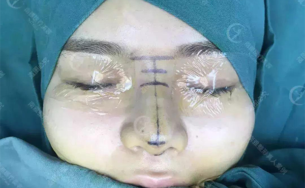 隆鼻術(shù)后多久能看到效果？