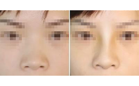 做隆鼻手術(shù)會(huì)留疤嗎？