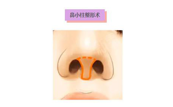 鼻小柱延長術(shù)是什么？鼻小柱延長手術(shù)有什么優(yōu)點