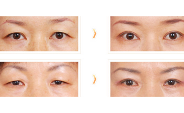 眼皮松弛下垂是什么原因?眼皮下垂提眉能解決嗎?